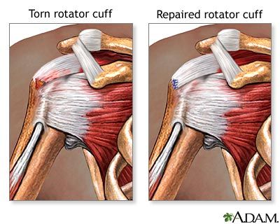 shoulder cuff injury